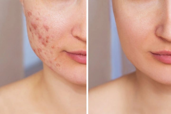 Say Goodbye to Redness & Breakouts: The Acne Treatment Ice Sleep Masque Your Skin Has Been Waiting For Honos Beauty