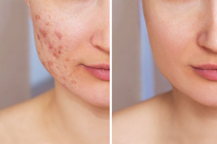 Say Goodbye to Redness & Breakouts: The Acne Treatment Ice Sleep Masque Your Skin Has Been Waiting For