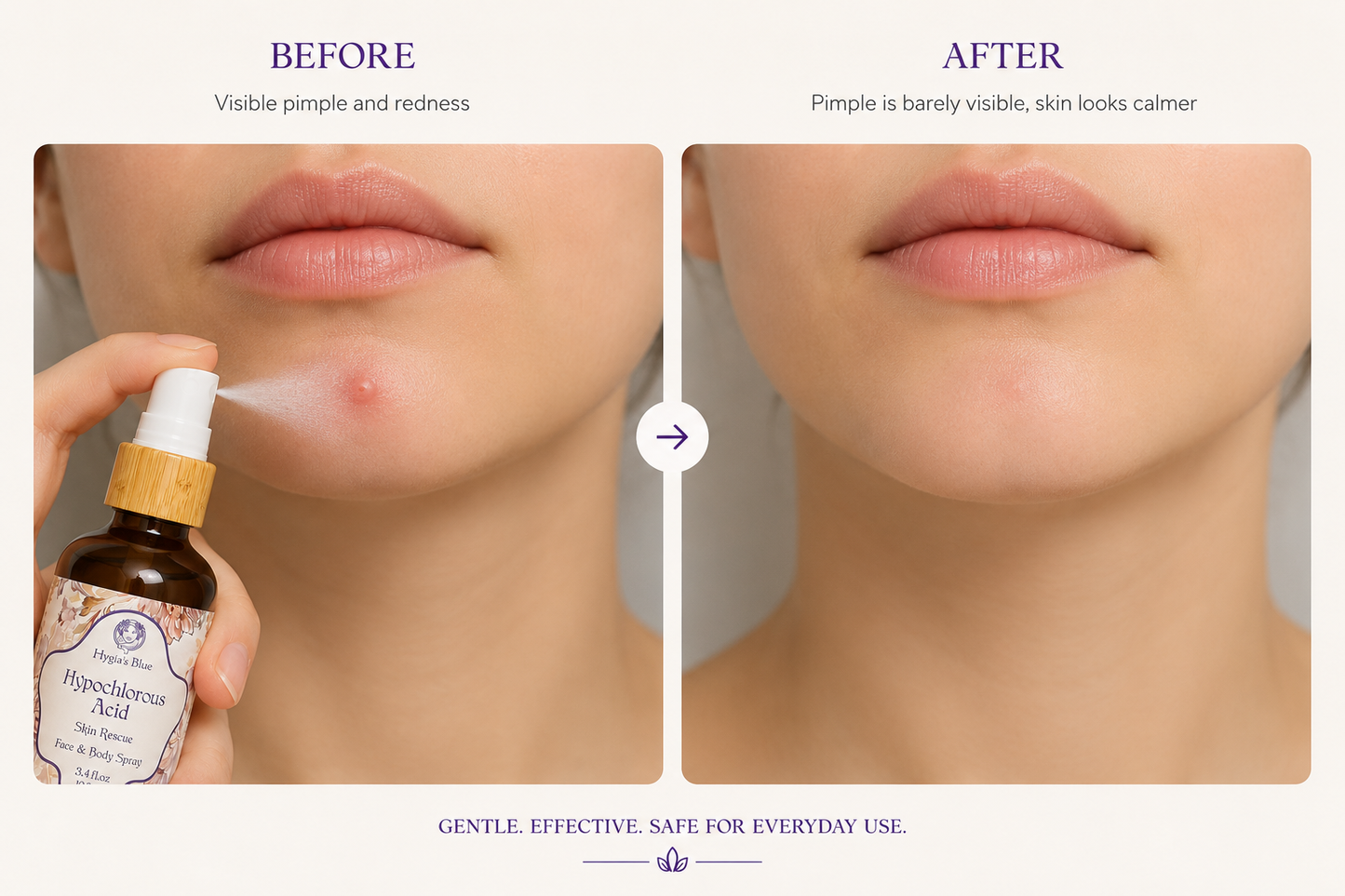 Hypochlorous Acid Spray - Defend the skin against harmful bacterias Hygia's Blue