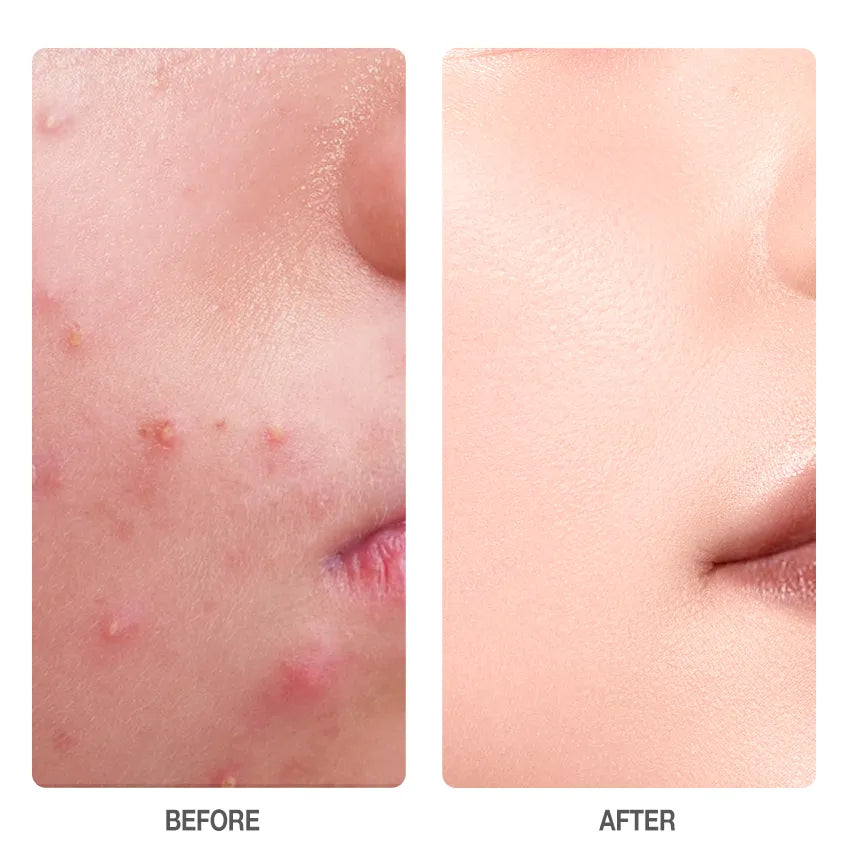 Salicylic Acid Acne Treatment Ice Sleep Masque