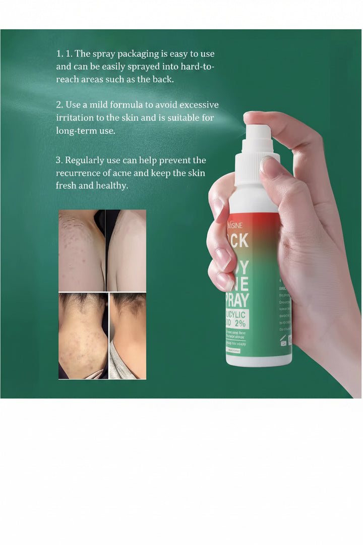 Body Acne Spray - 2% Salicylic Acid - Prevents Breakouts