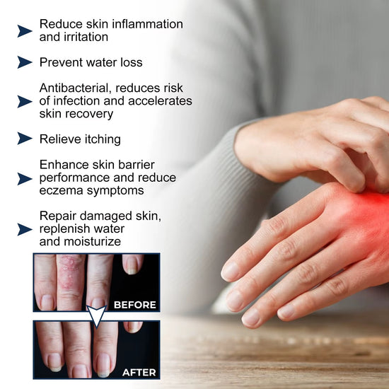 South Moon | Eczema Therapy Spray | Non-steroidal Formula Helps Calm Redness and Irritation