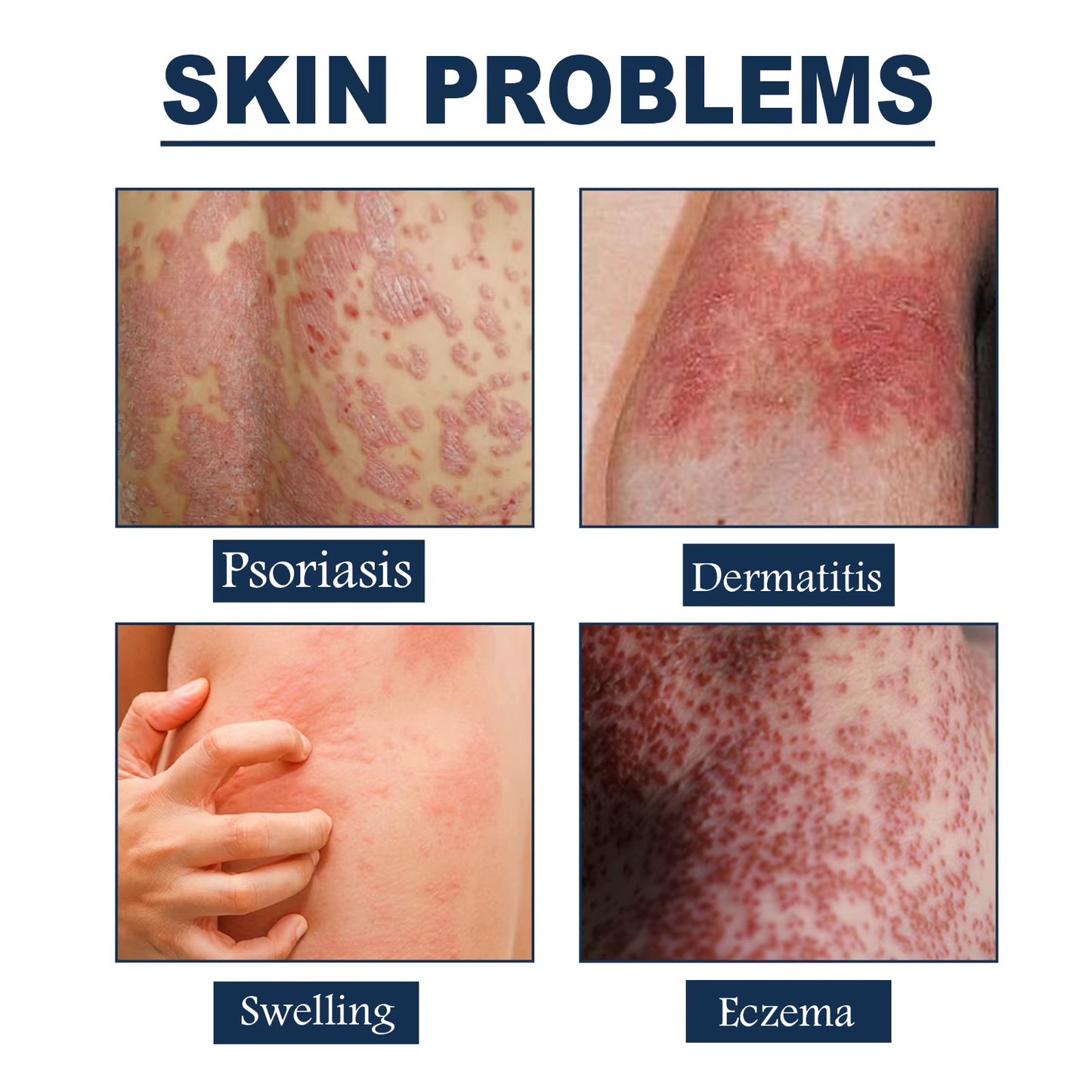 South Moon | Eczema Therapy Spray | Non-steroidal Formula Helps Calm Redness and Irritation