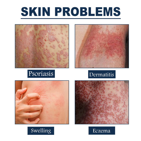 South Moon | Eczema Therapy Spray | Non-steroidal Formula Helps Calm Redness and Irritation