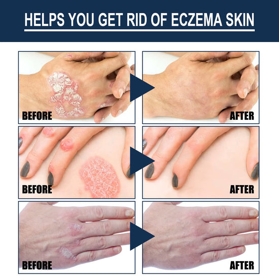 South Moon | Eczema Therapy Spray | Non-steroidal Formula Helps Calm Redness and Irritation